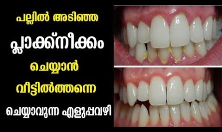 Teeth Whitening Tips Malayalam