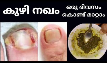 Toenail Treatment Malayalam