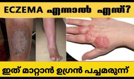 Eczema Treatment in Malayalam