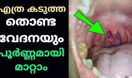 Throat Infection Treatment Malayalam