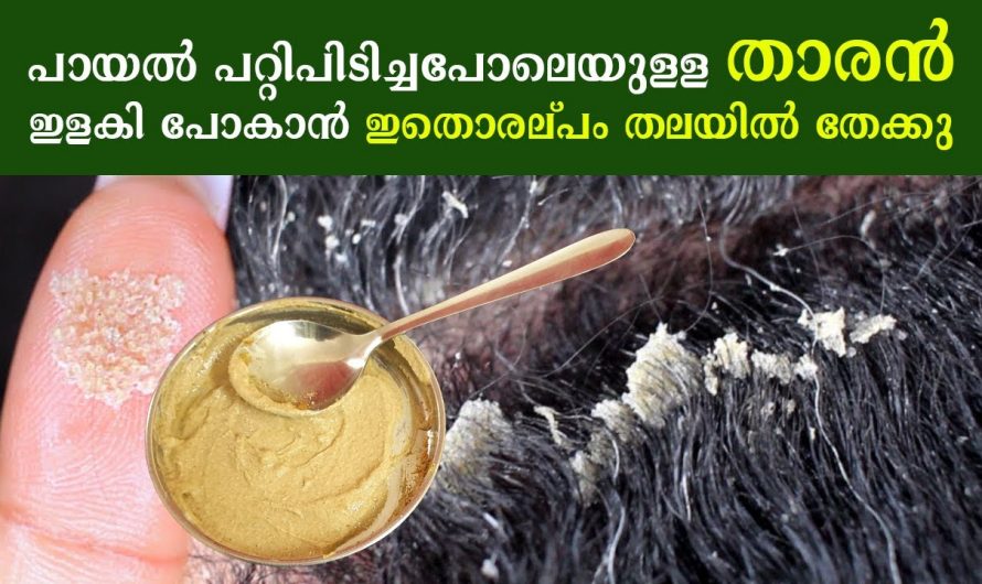 തലമുടിയിലെ പറ്റ പോലെയുള്ള താരൻ പരിഹരിച്ച് മുടിയെ സംരക്ഷിക്കാൻ. | Best Home Remedy for Dandruff