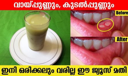 Mouth Ulcer Home Remedy