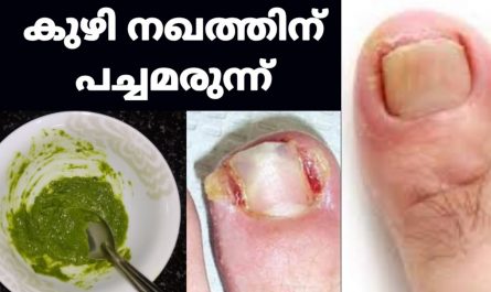 Toenail Fungus Treatment