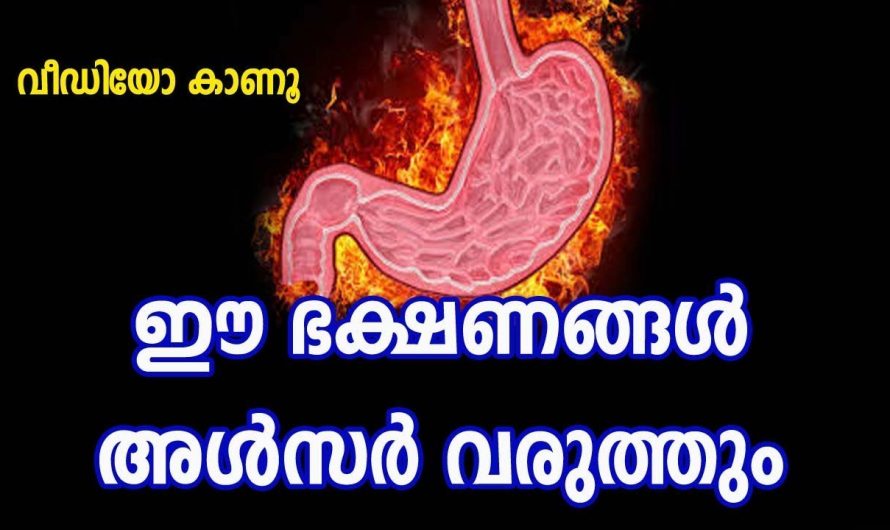 അൾസർ  ആരോഗ്യ പ്രശ്നത്തിന് പരിഹാരം കാണാൻ. | Ulcer home remedy