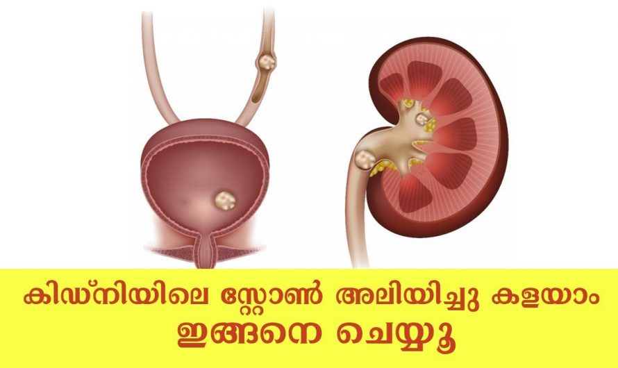 കിഡ്നി സ്റ്റോൺ എളുപ്പത്തിൽ പരിഹരിക്കാം. | Kidney Stone Remedies