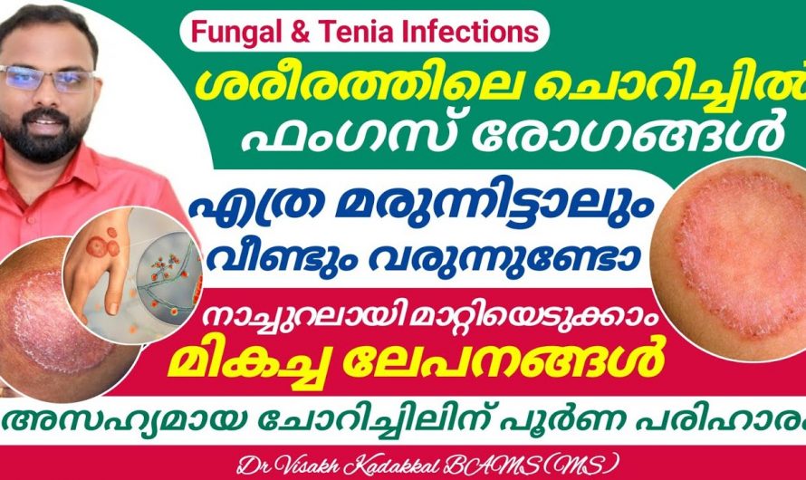 വട്ടച്ചൊറി പോലെയുള്ള ഫംഗസ് രോഗങ്ങളെ എങ്ങനെ പരിഹരിക്കാം.