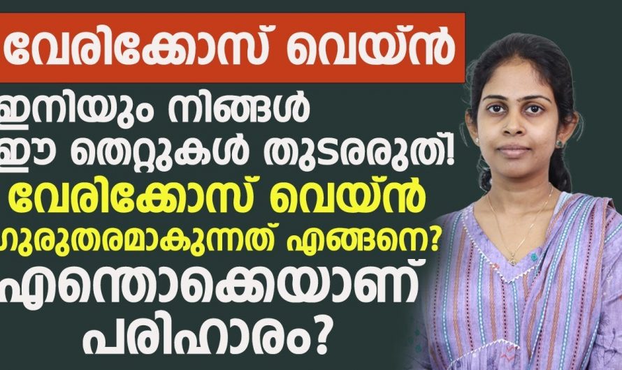 വെരിക്കോസ് വെയിൻ പരിഹരിച്ച് ആരോഗ്യം സംരക്ഷിക്കും.