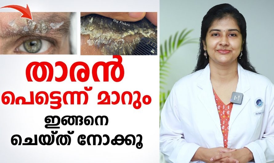 വീട്ടിലിരുന്നു കൊണ്ട് തന്നെ നമുക്ക് തലയിലെ താരനെ ഇല്ലാതാക്കാനുള്ള ഒരു പ്രകൃതിദത്തം ആയിട്ടുള്ള മാർഗങ്ങൾ