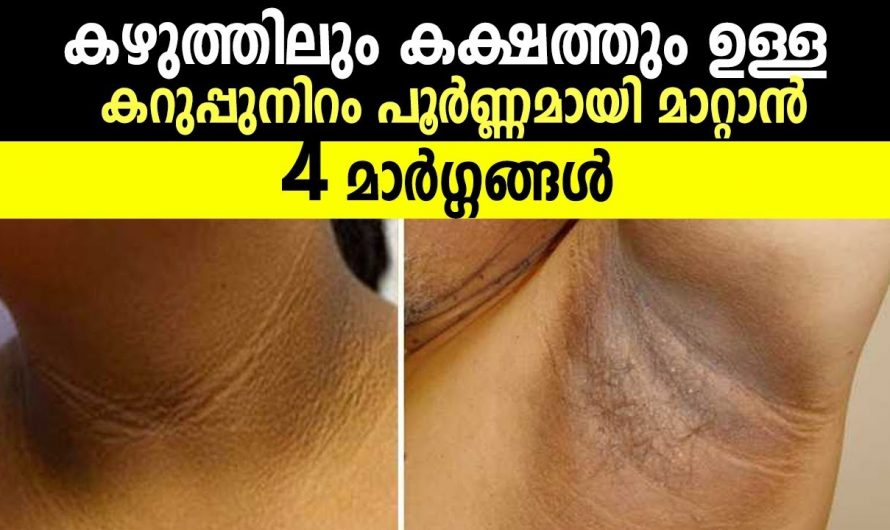 കഴുത്തിലെ മറ്റു സ്വകാര്യ ഭാഗങ്ങളിലെയും കറുപ്പ് നിറവും കരിവാളിപ്പും നീക്കം ചെയ്യാൻ ഇതാ കിടിലൻ വഴി..