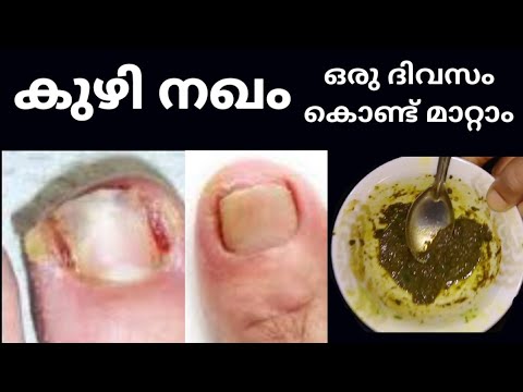 ഒരു ദിവസം കൊണ്ട് കുഴിനഖം നമുക്ക് മാറ്റിയെടുക്കാം