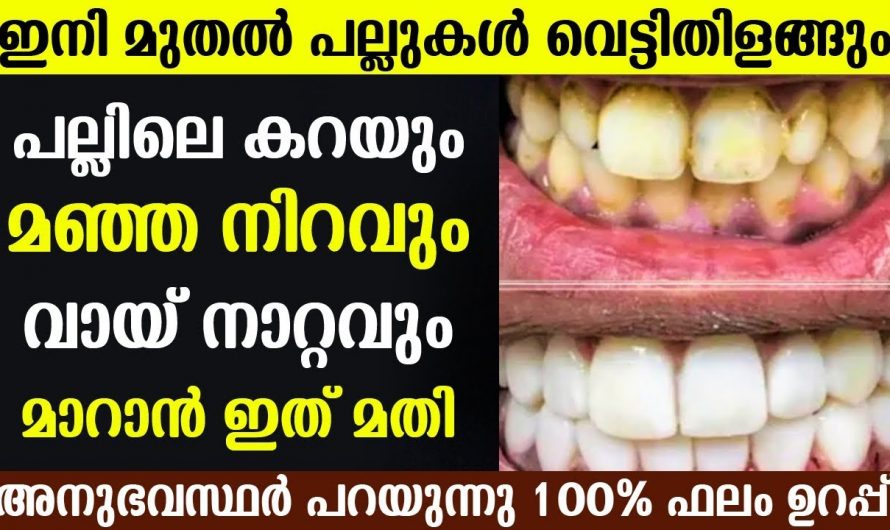 ഇത്തരം വീട്ടുവൈദ്യങ്ങൾ ഉപയോഗിച്ച് നമുക്ക് പല്ലിന്റെ കറയും അതുപോലെതന്നെ മഞ്ഞനിറവും മാറ്റിയെടുക്കാം