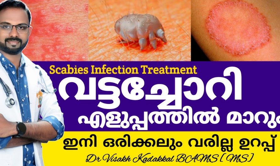 വേനൽക്കാലമായാൽ ഉണ്ടാകുന്ന വട്ടച്ചൊറി യെ കുറിച്ച് അറിയാം