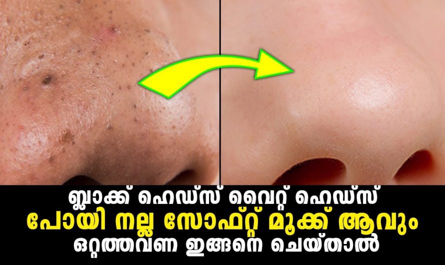 മുഖചർമ്മത്തിലെ കറുത്ത പാടുകളും കുരുക്കളും കുത്തുകളും നീക്കം ചെയ്യാൻ കിടിലൻ വഴി..