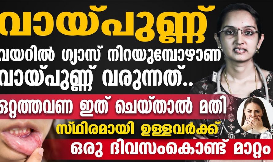 ഒരൊറ്റ തവണ ഇങ്ങനെ ചെയ്തു നോക്കൂ വായ്പുണ്ണ് മാറ്റിയെടുക്കാം