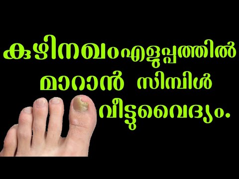 കുഴിനഖം എളുപ്പത്തിൽ പരിഹരിക്കാം…