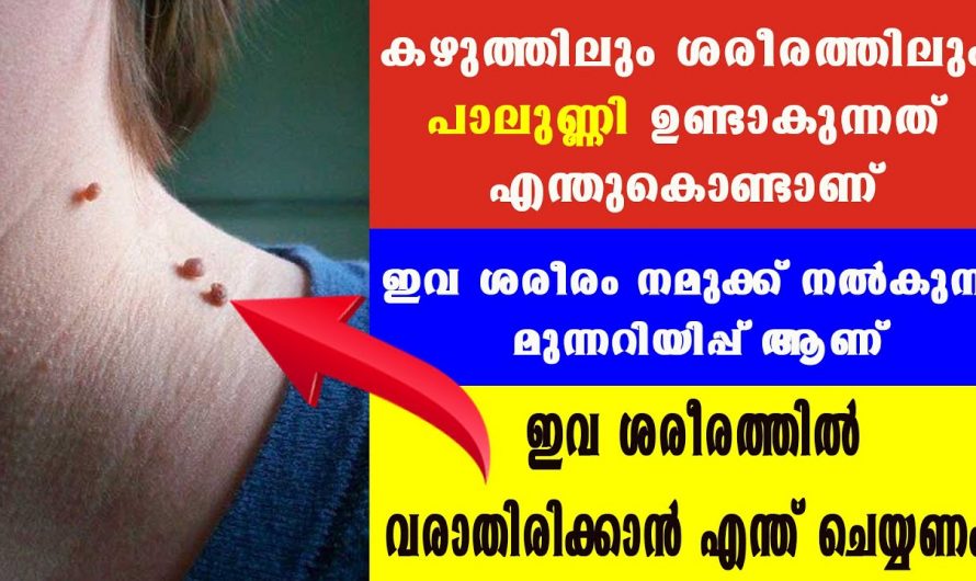 ചർമ്മത്തിലെ പാലുണ്ണികൾ നീക്കം ചെയ്യുന്നതിനും ഇനി വരാതിരിക്കാനും…😱