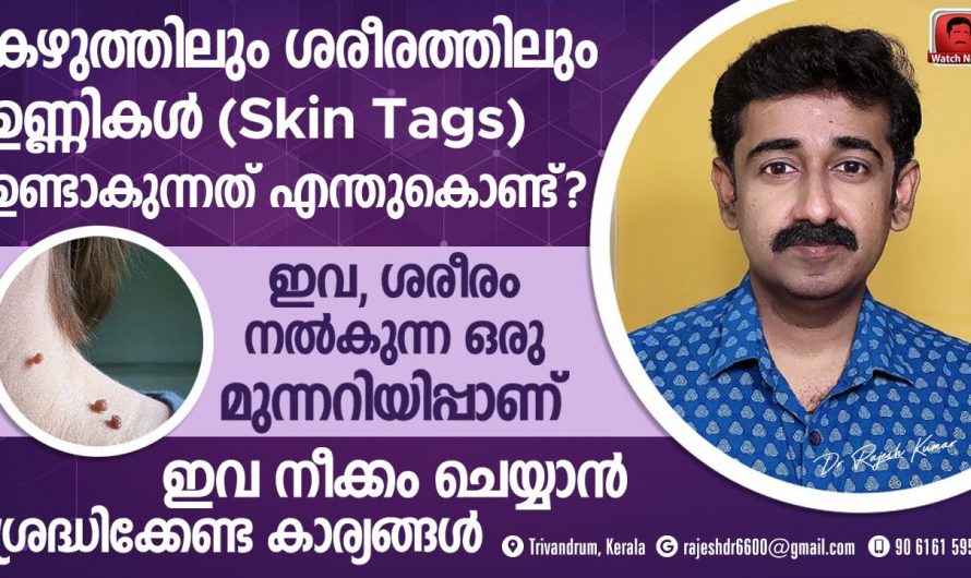 സൗന്ദര്യ സംരക്ഷണത്തിന്  വെല്ലുവിളികൾ ഉയർത്തുന്ന സ്കിൻ ടാഗുകൾ എങ്ങനെ നീക്കം ചെയ്യാം…😱