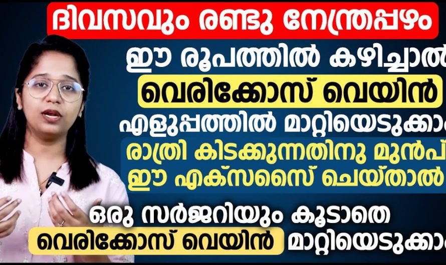 വെരിക്കോസ് വെയിൻ എളുപ്പത്തിൽ ഇല്ലാതാക്കാം…👌