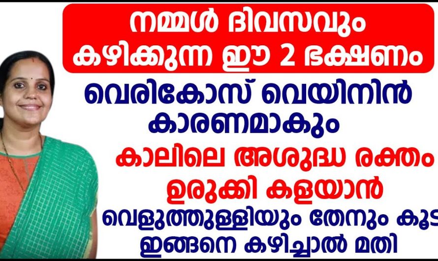 ഉത്തരം ഭക്ഷണങ്ങൾ വെരിക്കോസ് വെയിൻ പ്രശ്നങ്ങൾ കുറയ്ക്കുവാൻ സഹായിക്കും🥰