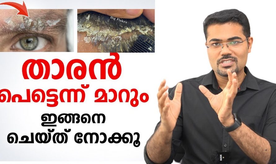 താരൻ പരിഹരിക്കുന്നതിന് കിടിലൻ വഴി…👌