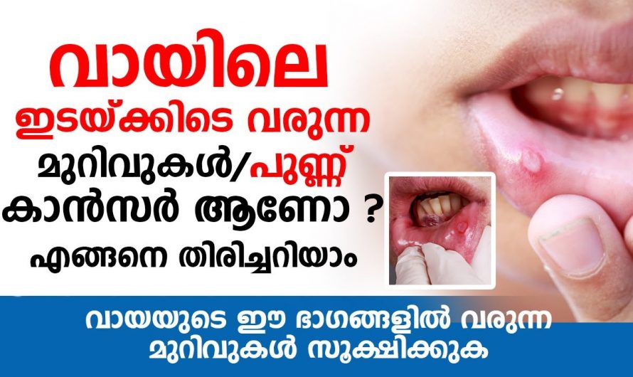 വായയിൽ ഉണ്ടാകുന്ന പുണ്ണ് ക്യാൻസർ ആണോ എങ്ങനെ തിരിച്ചറിയാം🥰
