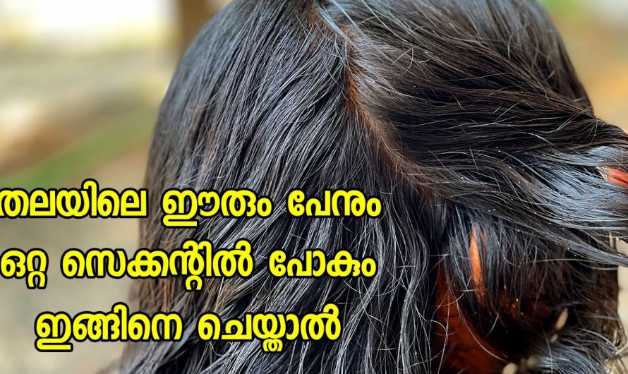 തലയിലെ പേനും ഈരും ഇനി ഉണ്ടാവുകയില്ല ഇങ്ങനെ ചെയ്താൽ.