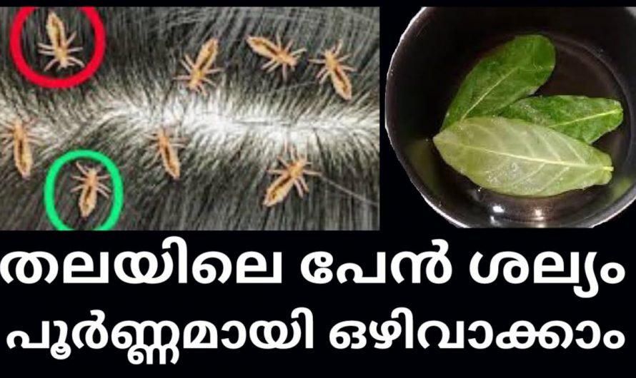 തലമുടിയിലെ ഈരും പേൻ ശല്യം എളുപ്പത്തിൽ പരിഹരിക്കാം…