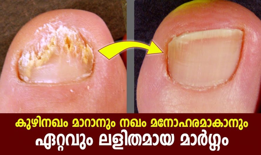 നഖം പൊട്ടിപ്പോകുന്ന ആളുകളാണോ നിങ്ങൾ എങ്കിൽ ഇതൊന്നു കണ്ടു നോക്കൂ.