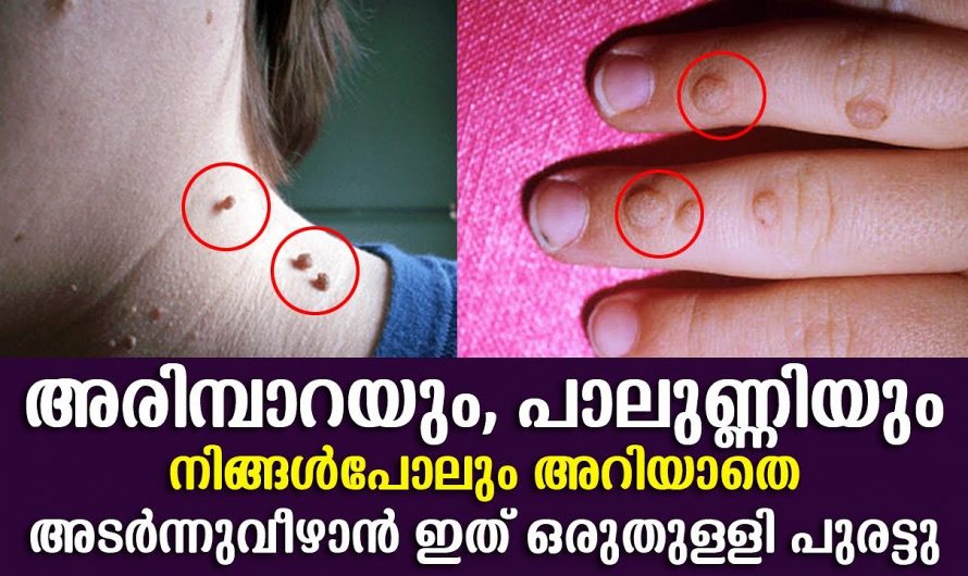 നമ്മുടെ ശരീരത്തിലെ അരിമ്പാറയും പാലുണ്ണിയും എളുപ്പത്തിൽ ഇല്ലാതാക്കാം ഇതാ കിടിലൻ വഴി..