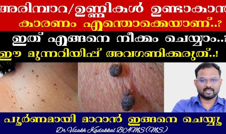 ചർമ്മത്തിൽ ഉണ്ടാകുന്ന പാലുണ്ണികൾ എളുപ്പത്തിൽ നീക്കം ചെയ്യാം..