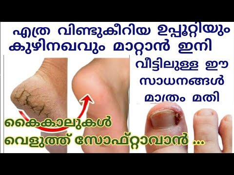വളരെ എളുപ്പത്തിൽ തന്നെ നമ്മുടെ കാൽപാദങ്ങളുടെ വിള്ളലും കുഴിനഖും പരിഹരിച്ച് സുന്ദരമാക്കാം.