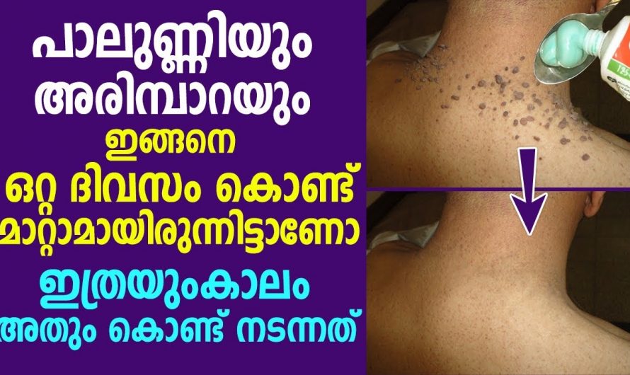 ചർമ്മത്തിന്റെ ഭംഗി നഷ്ടപ്പെടുത്തുന്ന  അരിമ്പാറ പാലുണ്ണി എന്നിവ എളുപ്പത്തിൽ നീക്കം ചെയ്യാൻ..